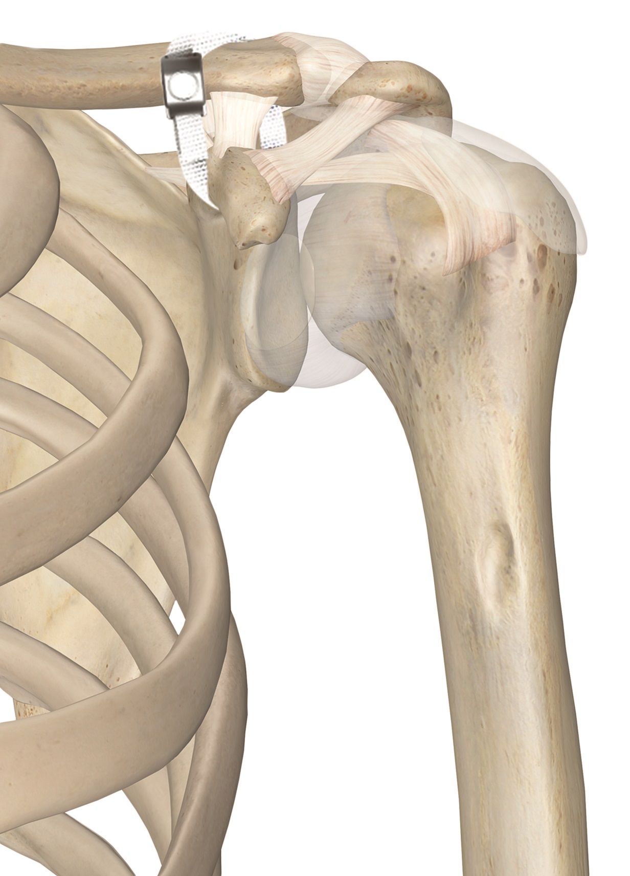 Ortholox®Gh UHMWPE AC Joint Internal Bracing System