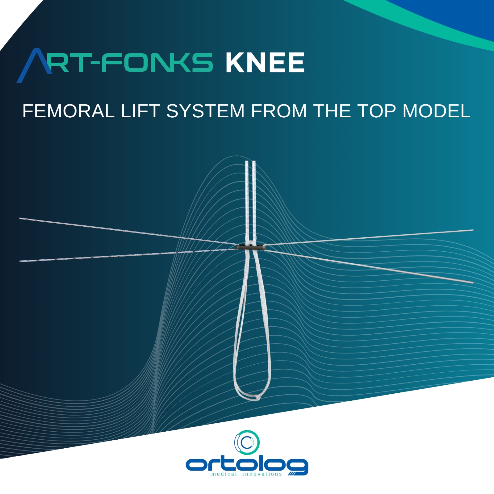 Art-Fonks Knee Arthroscopy-Lift Systems, Screws, Staples and Wires