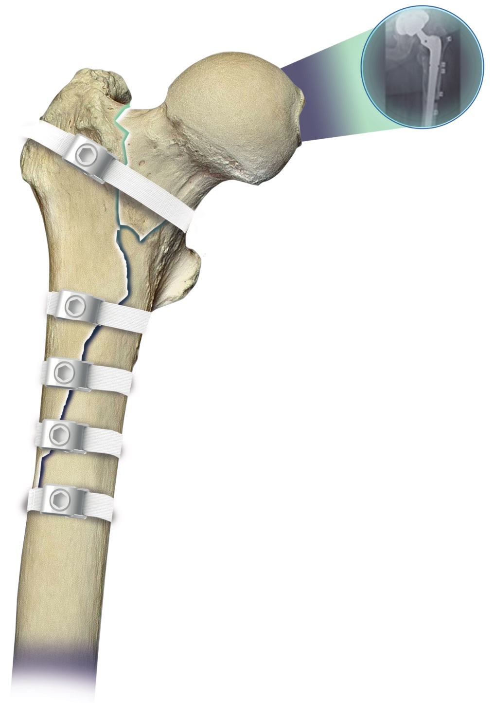 Ortholox® UHMWPE Cerclage Band System