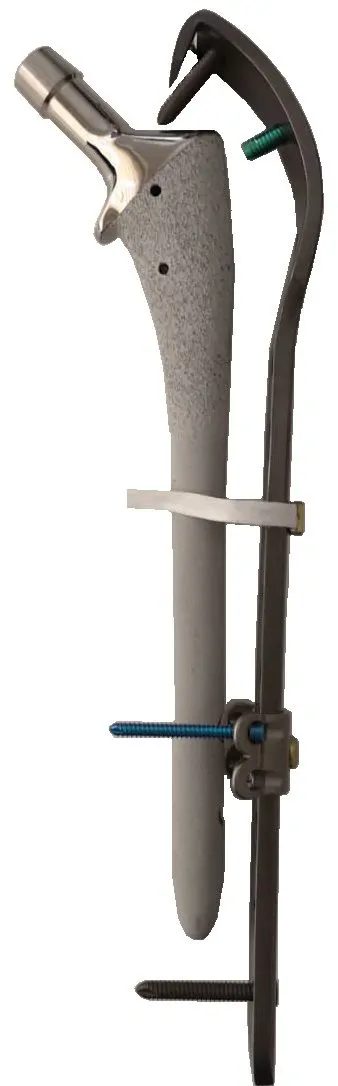 Ortholox® Locking Periprosthetic Support Cable-Plate Systems