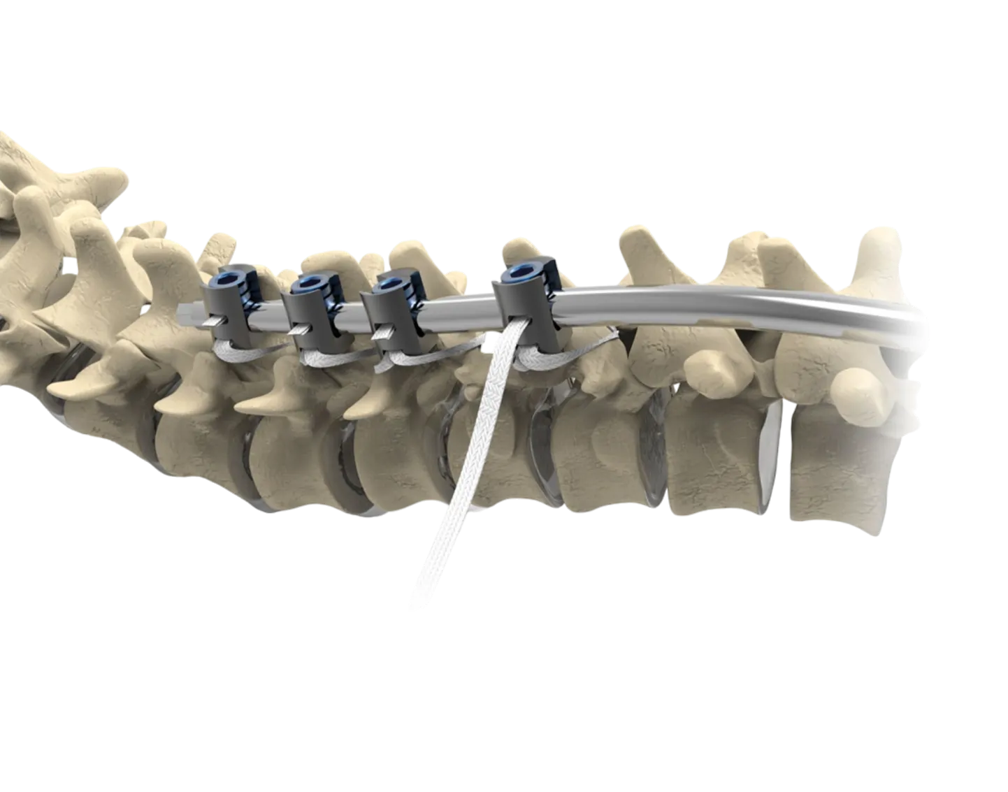 Ortholox® UHMWPE Spinal Posterior Fixation System