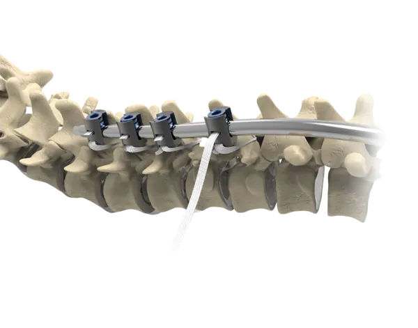 Ortholox® UHMWPE Spinal Posterior Fixation System